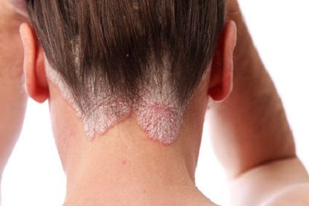 Novedades mitos de la psoriasis 1