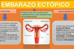 embarazo ectopico
