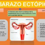 embarazo ectopico