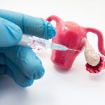 ¿Qué es la hiperestimulación ovárica?