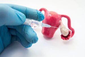 ¿Qué es la hiperestimulación ovárica?